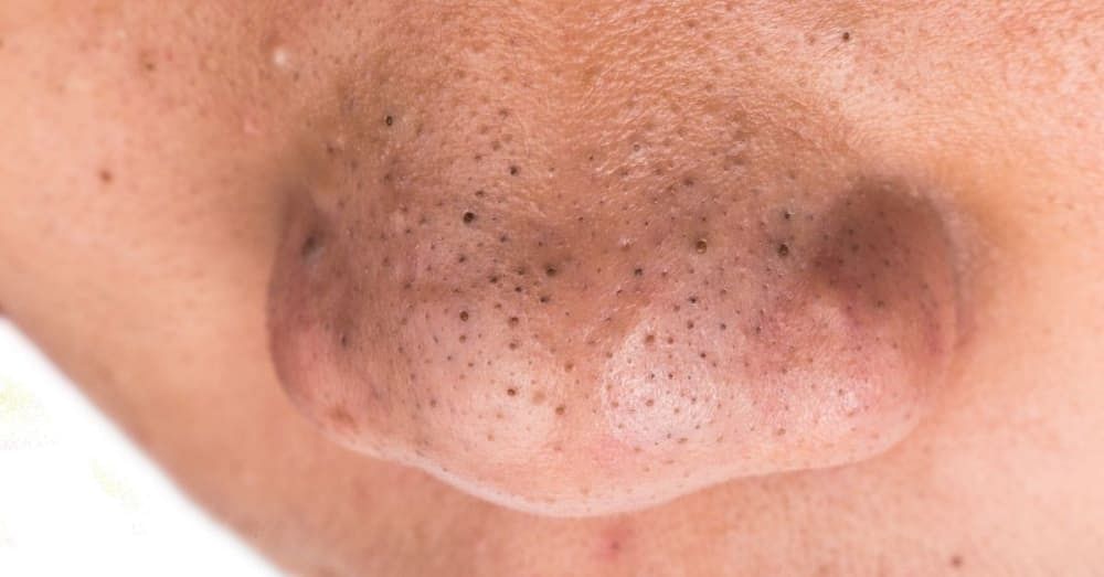 How to Get Rid of Blackheads on Nose – According to a Dermatologists